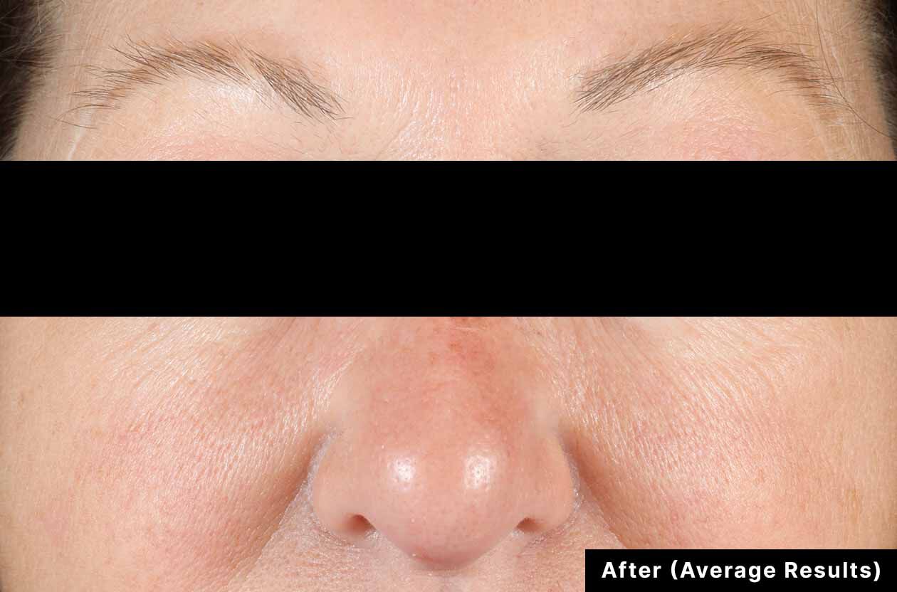 Before and after comparison of a nose with 'After (Average Results)' text.