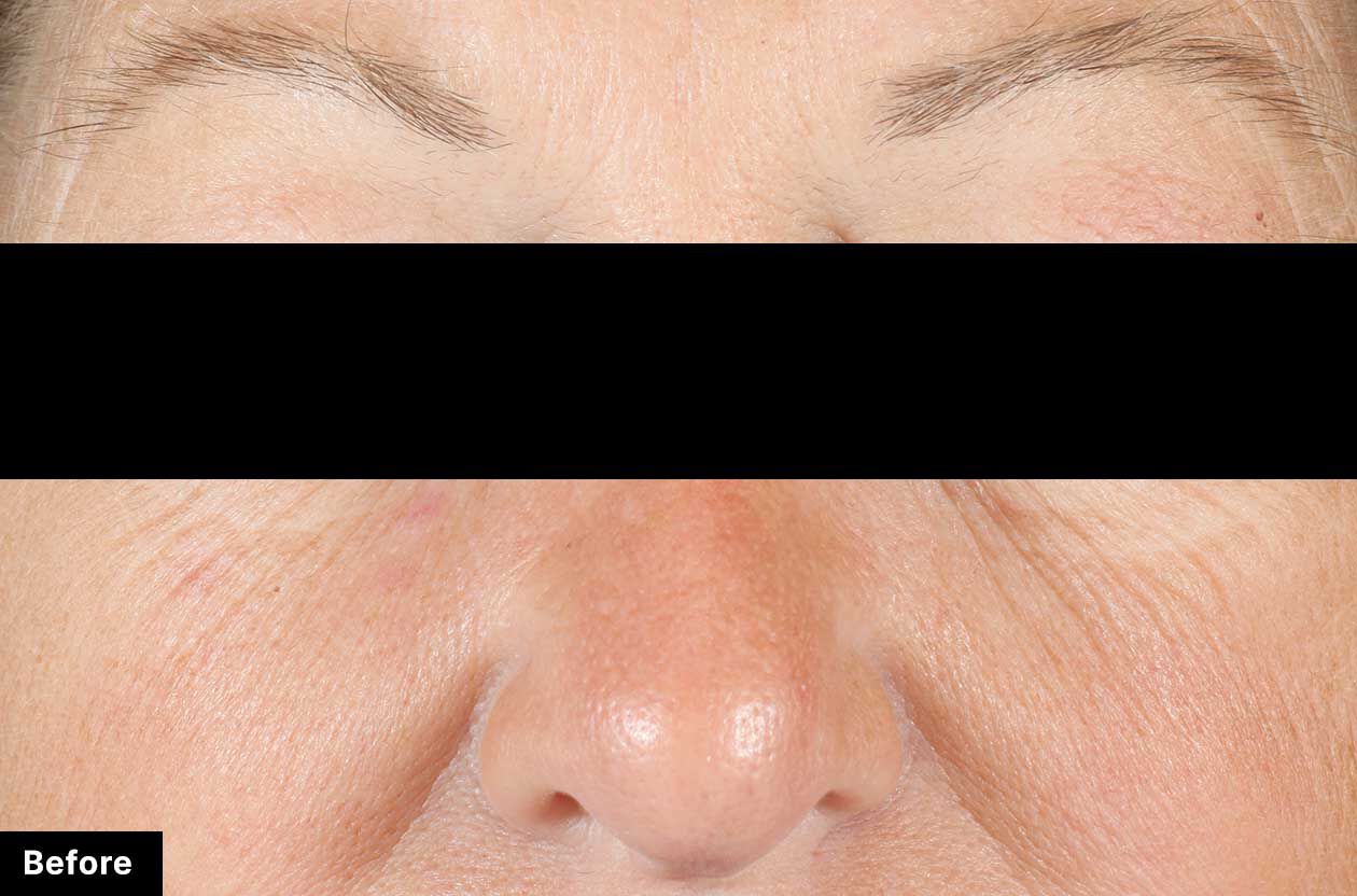 Close-up of a person's nose with 'Before' label on a black background