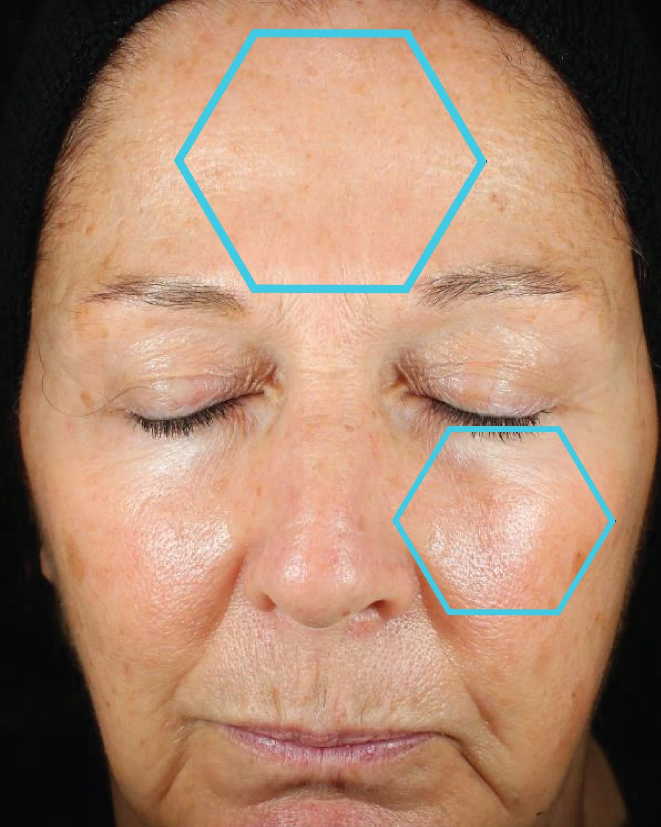 Facial close-up with blue hexagonal markers on skin texture and pores