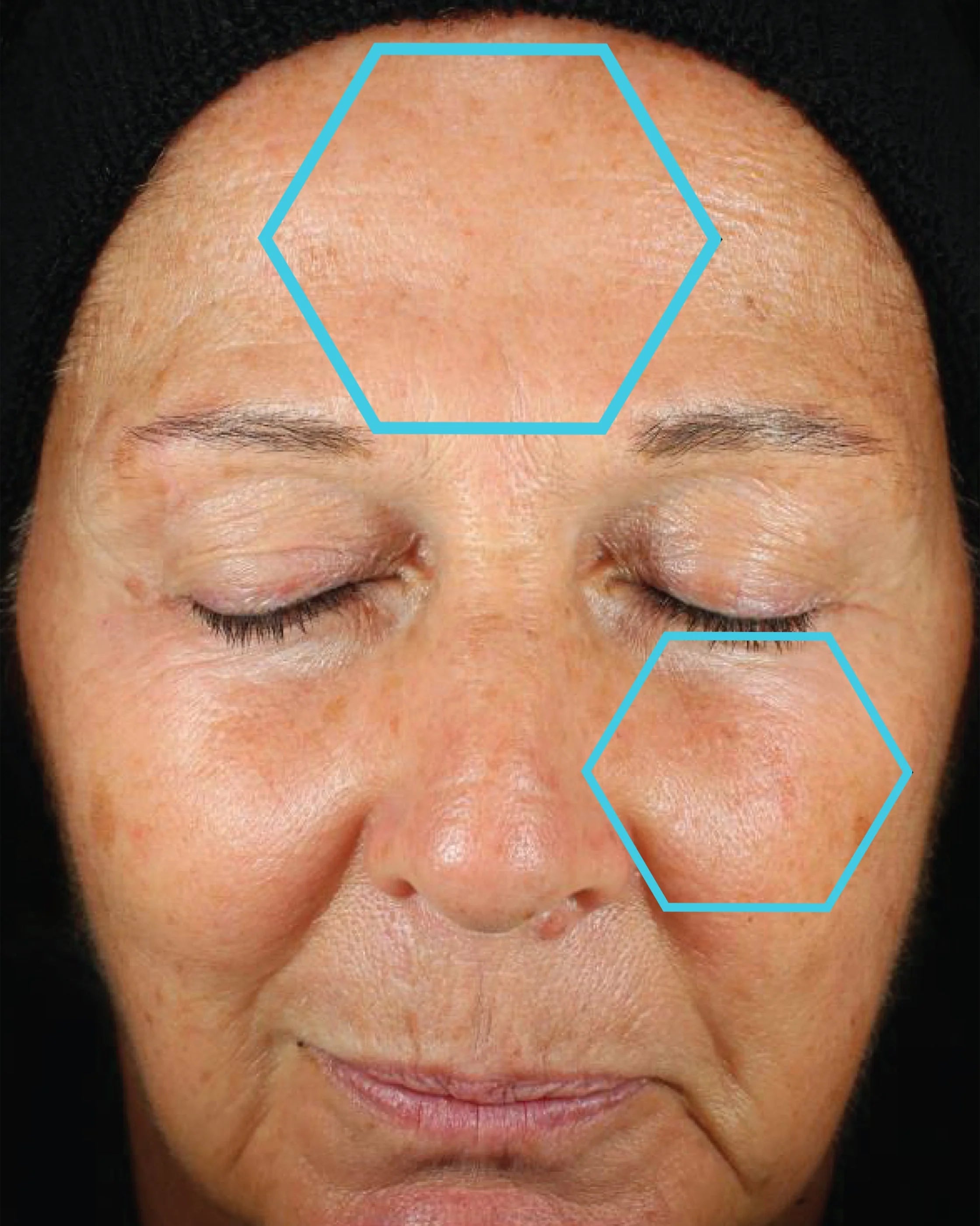 Close-up of a person's face with blue hexagonal markers on the forehead and cheek area