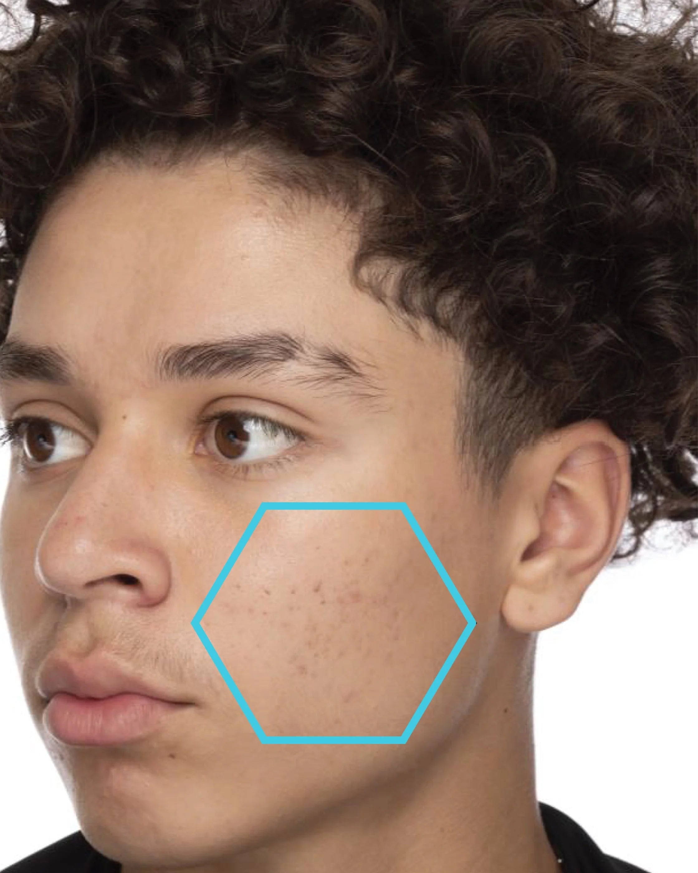 Close-up of a person's face with a blue hexagon highlighting facial acne.