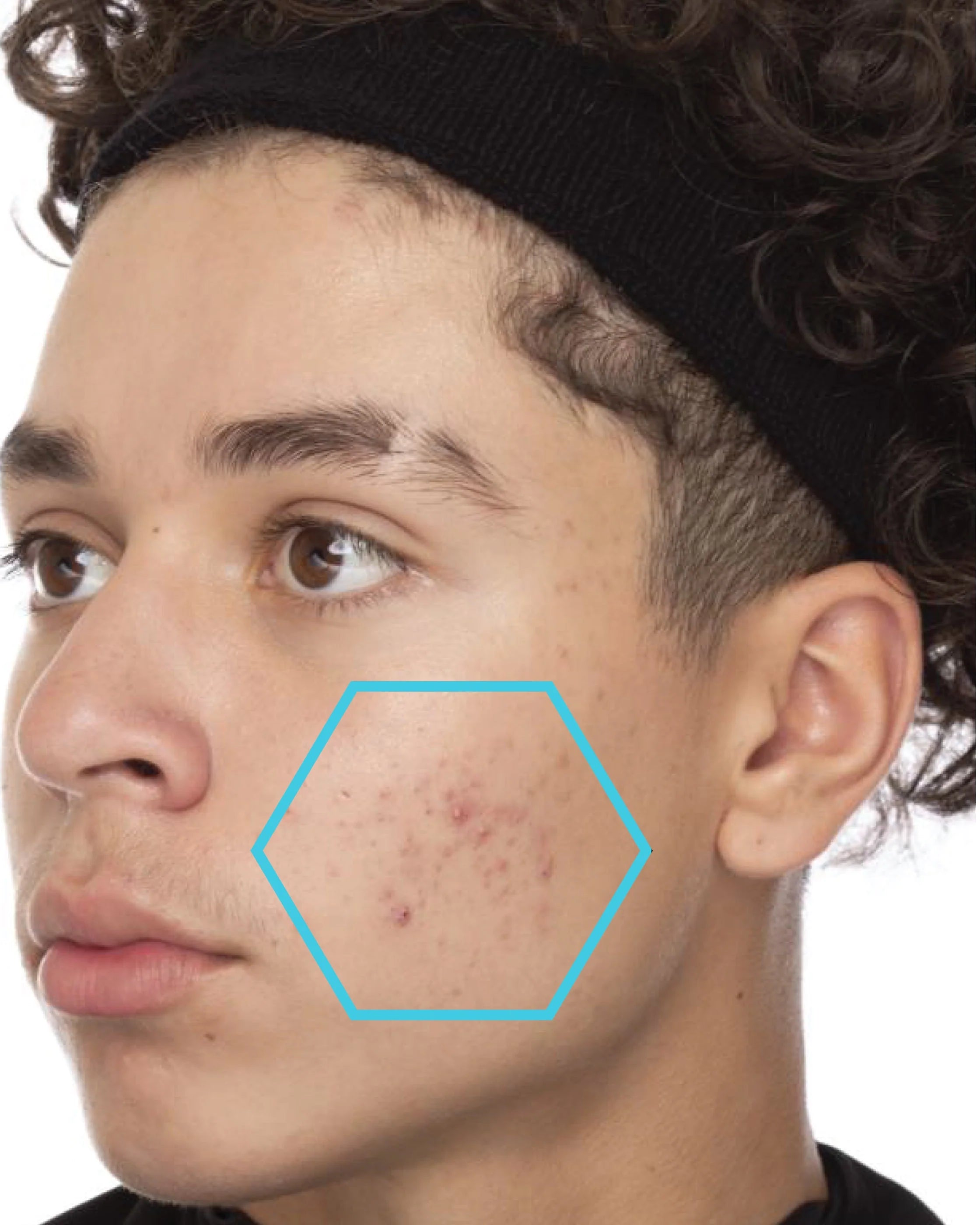 Close-up of a person's face with acne highlighted by a blue hexagon on a white background