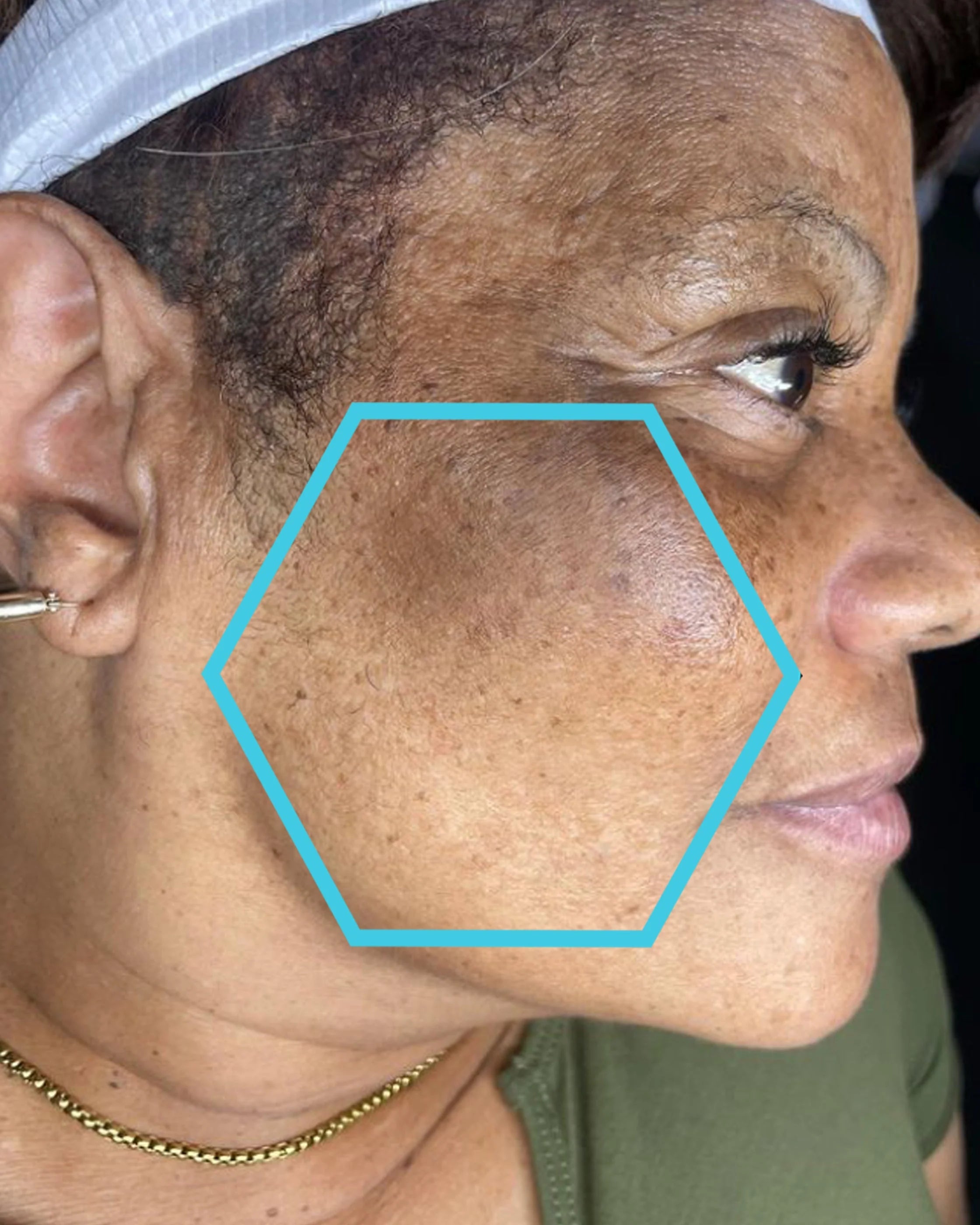Close-up of a person's face with a blue hexagon highlighting skin texture.
