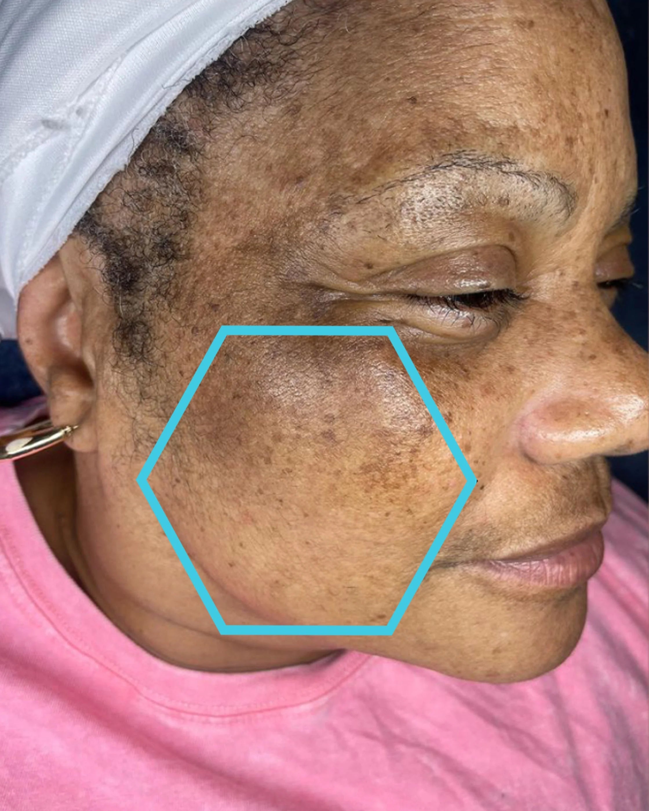 Close-up of a person's face with a blue hexagon highlighting a skin concern.