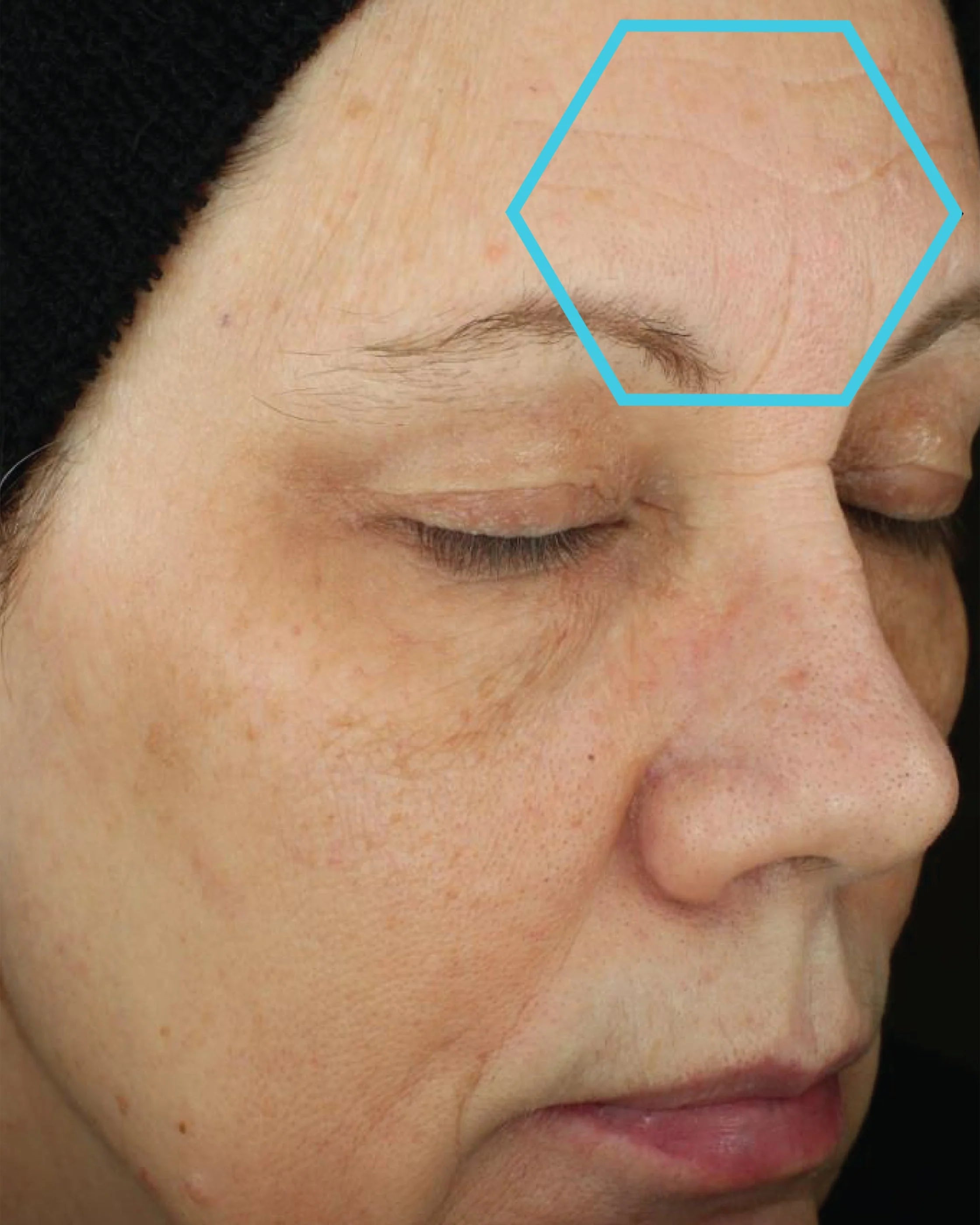 Close-up of a person's face with a focus on wrinkles around the eye area.