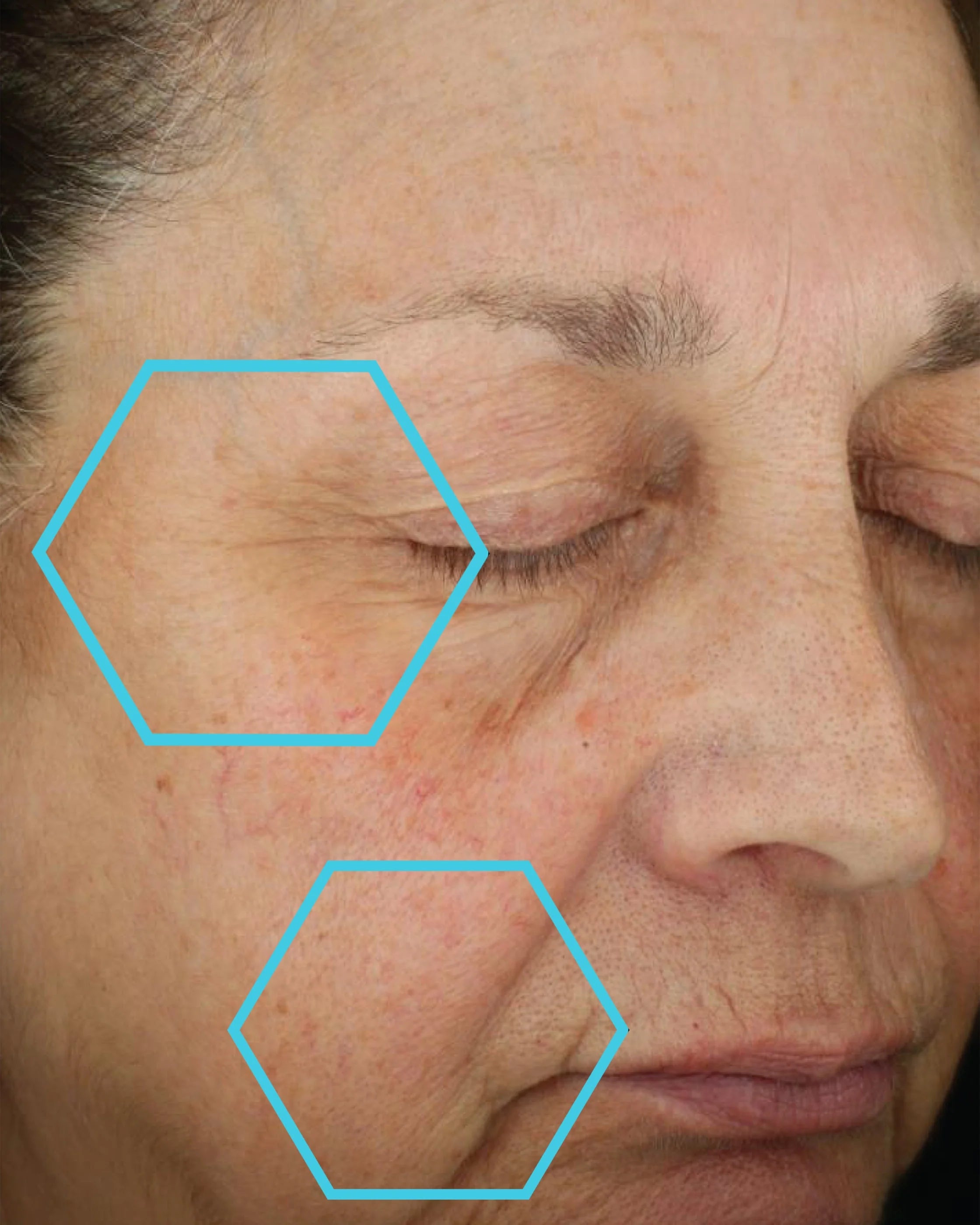 Close-up of a person's face with visible skin texture and redness, highlighted by blue hexagonal markers.