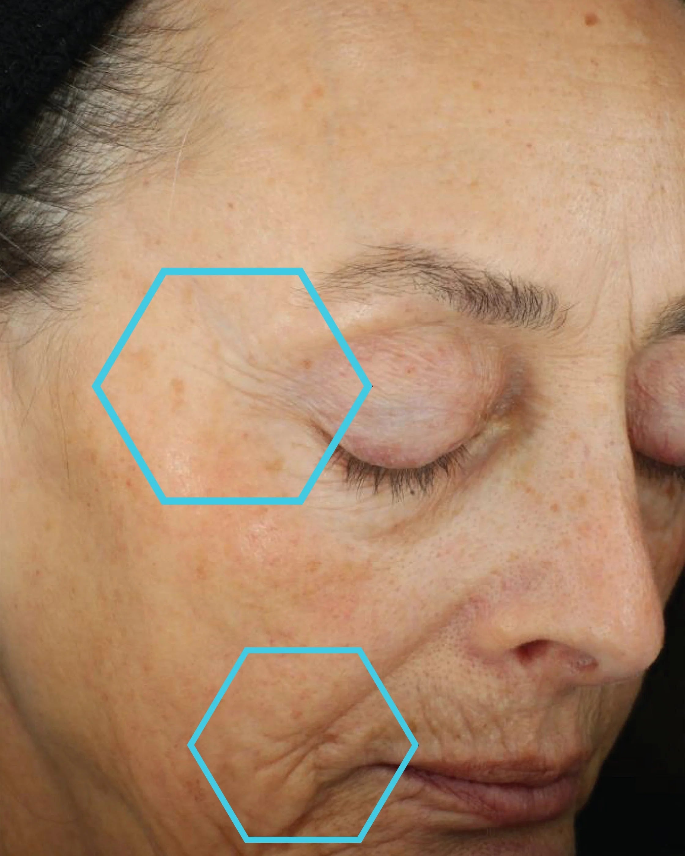 Close-up of a person's face with wrinkles highlighted by blue hexagons.
