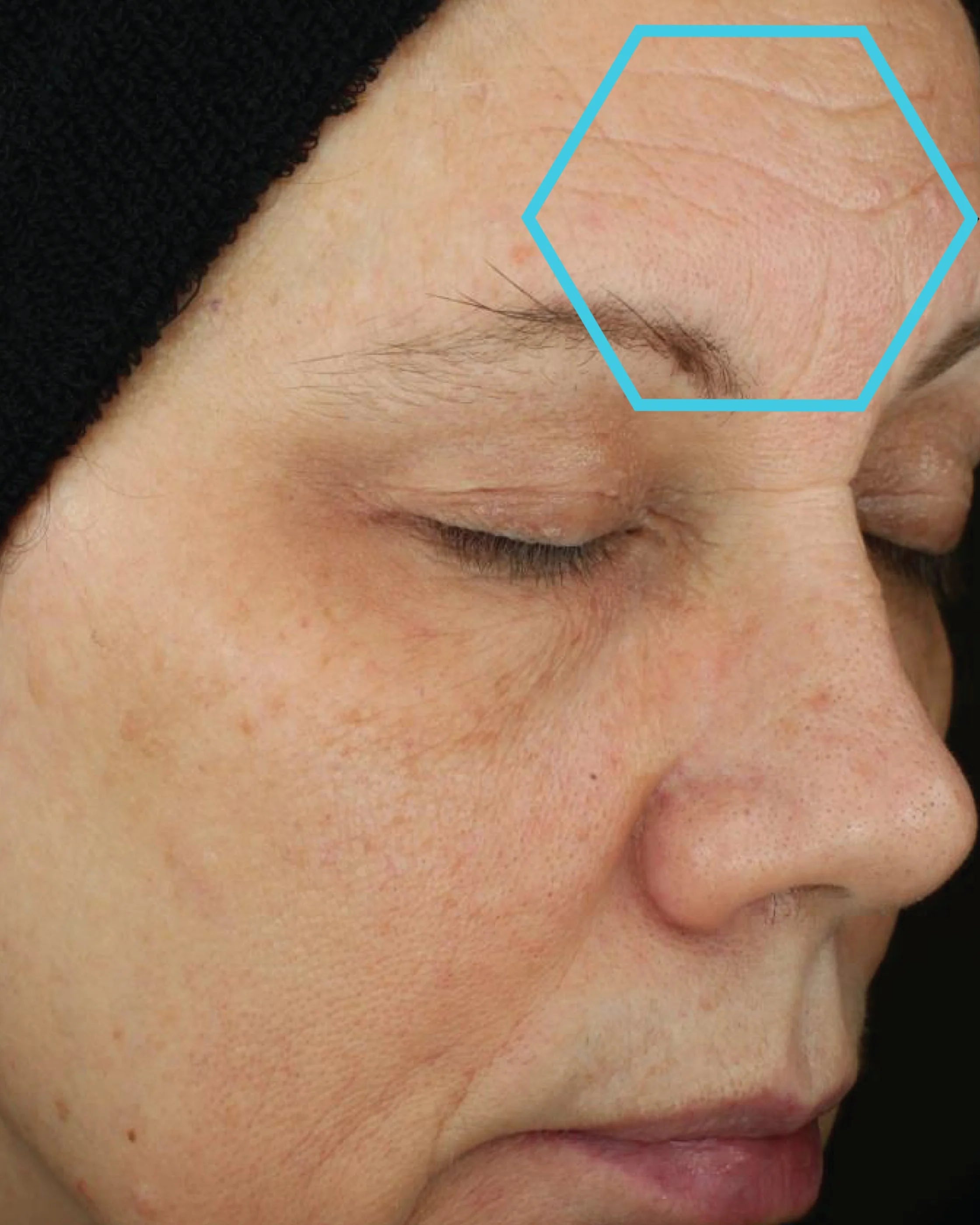 Close-up of a person's face with a focus on wrinkles around the eye area.