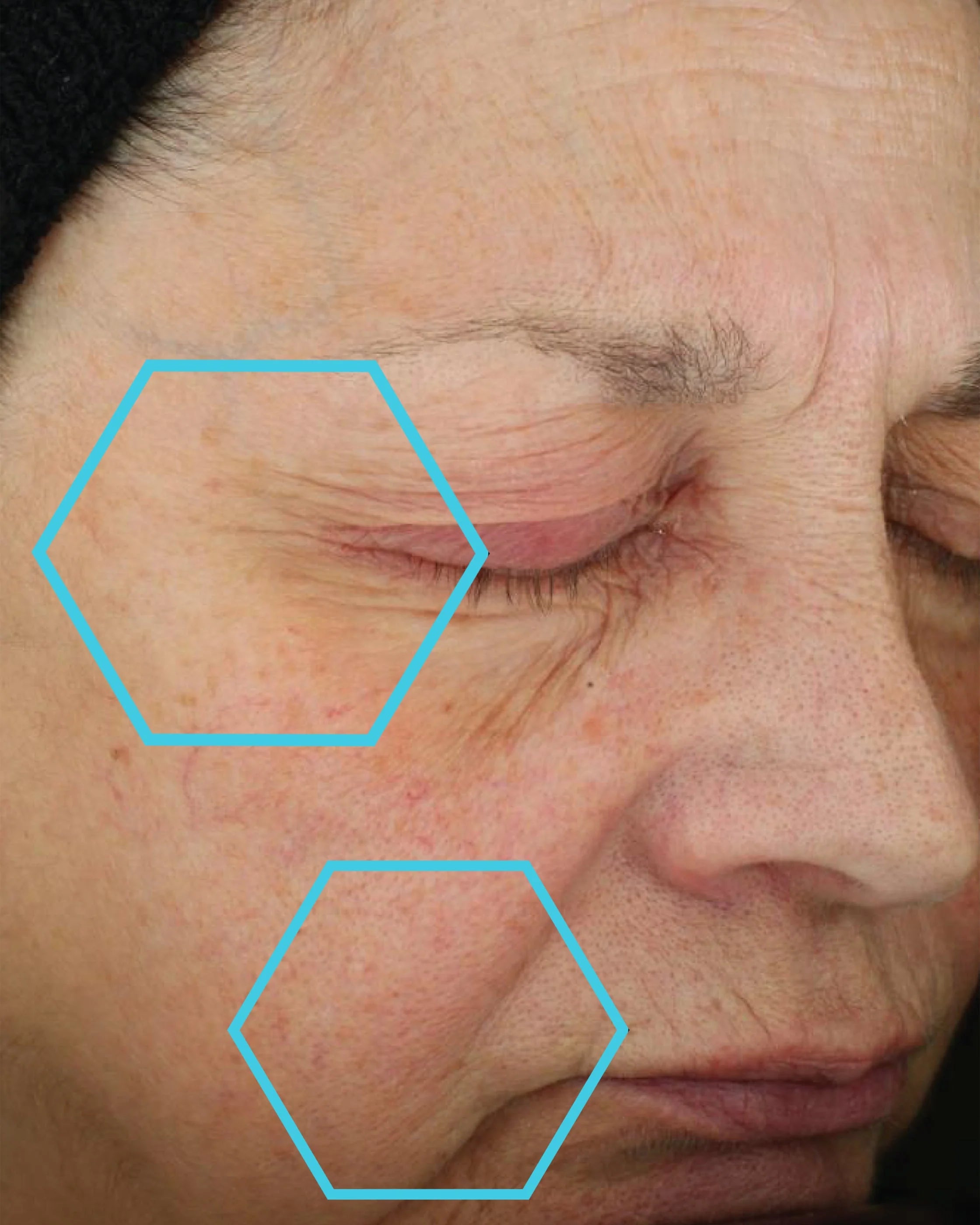 Close-up of a person's face with visible wrinkles and skin texture, highlighted by blue hexagonal markers.