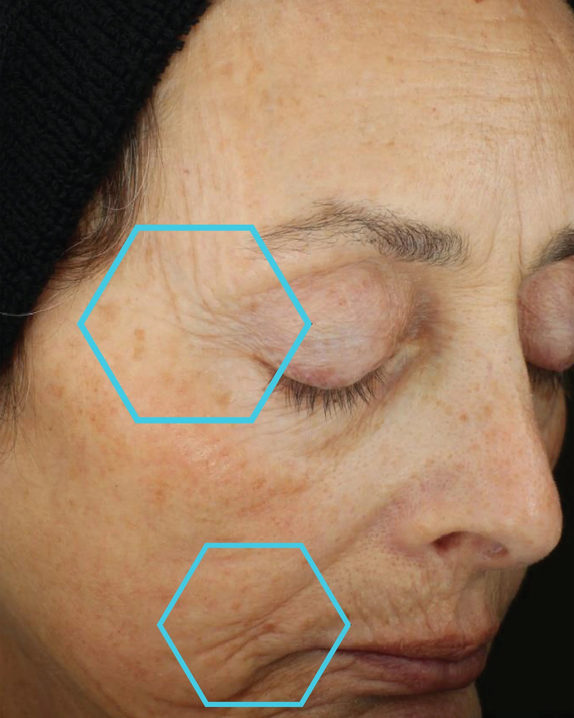 Close-up of a person's face with visible wrinkles and skin texture, highlighted by blue hexagons.