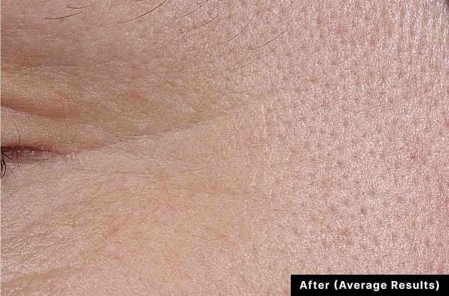 Close-up of skin texture labeled 'After (Average Results)'