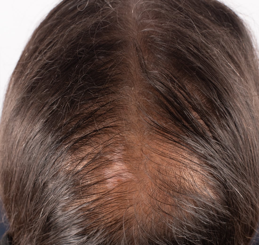 Close-up of a person's scalp with visible hairline and skin texture.