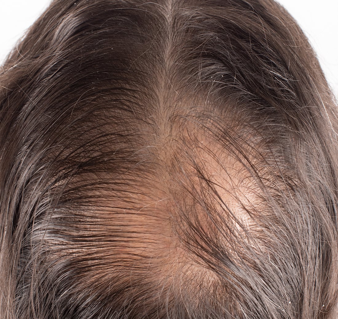 Close-up of a person's scalp with visible hair texture and color.
