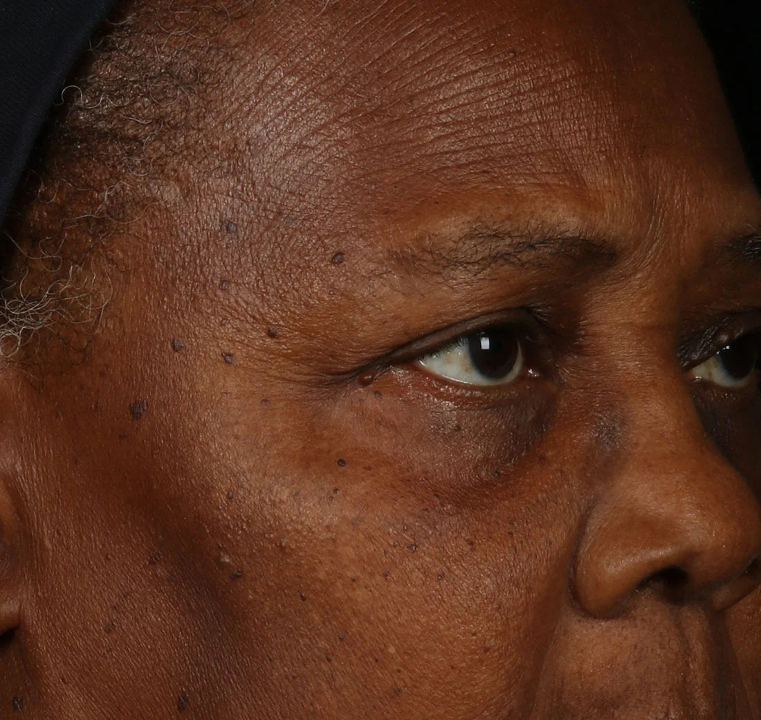 Close-up of a person's face with a focus on the skin texture.