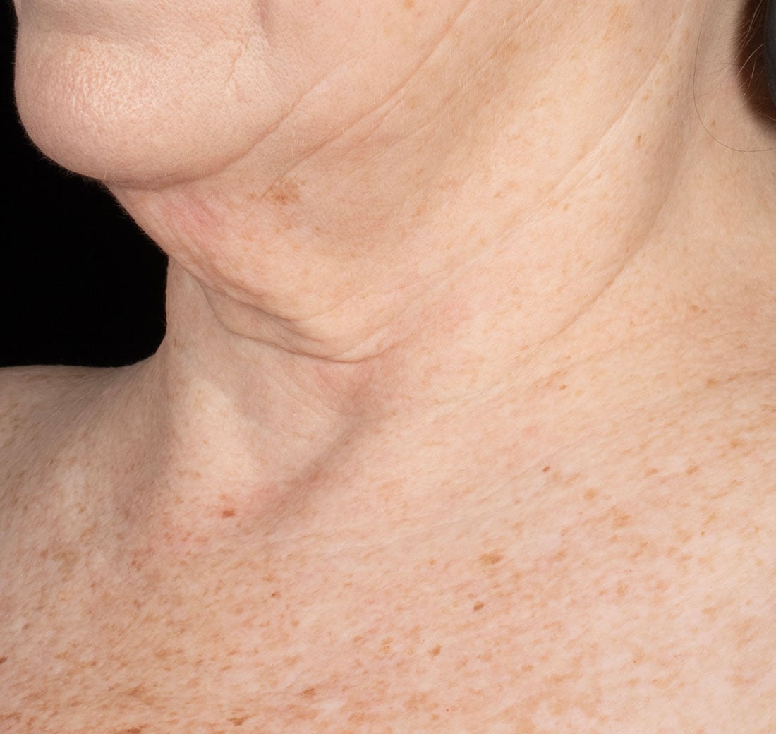 Close-up of a person's neck with visible skin texture and lines.