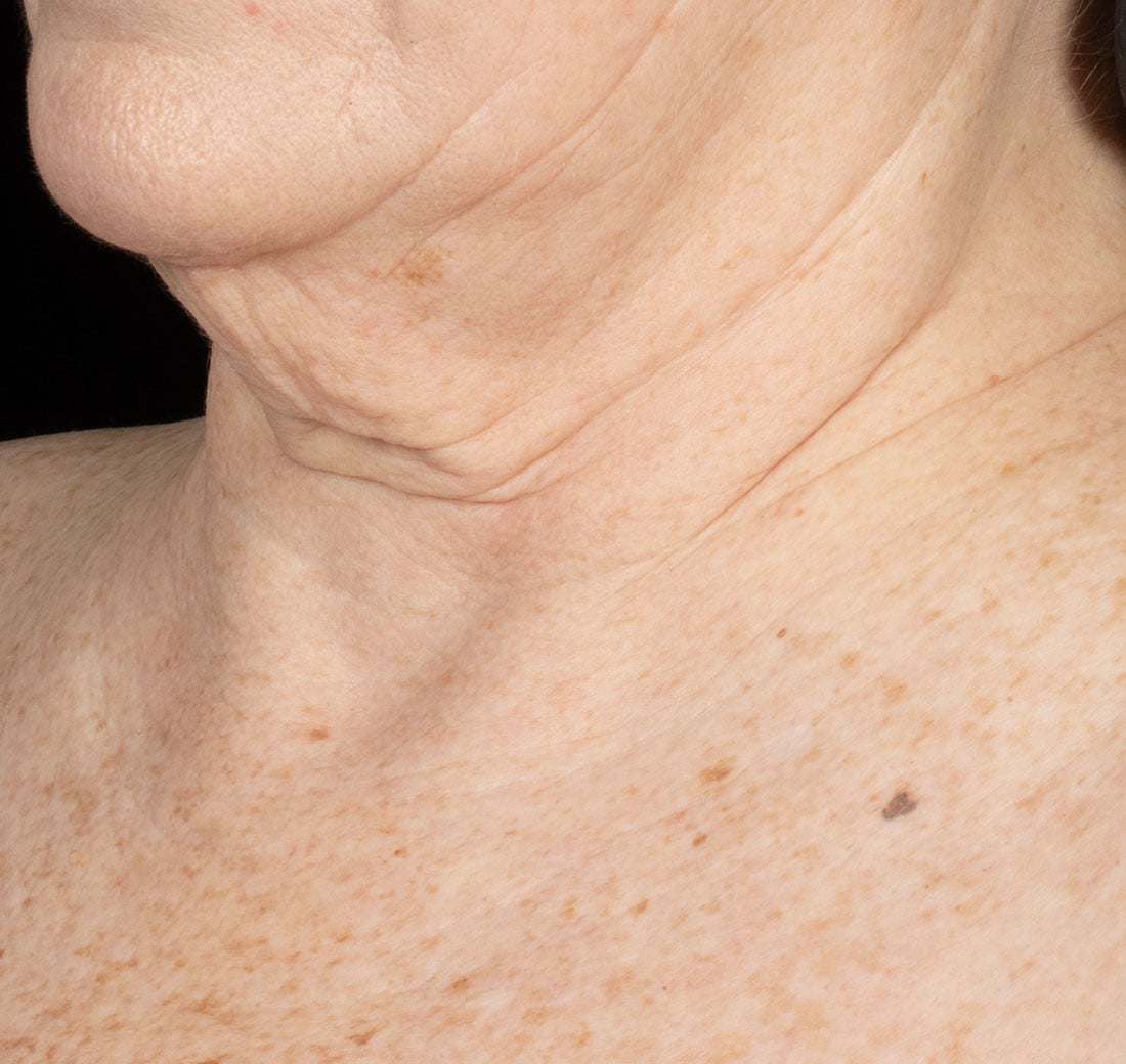 Close-up of a person's neck and shoulder with visible skin texture and lines.