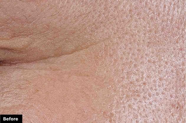 Close-up of skin texture with 'Before' label