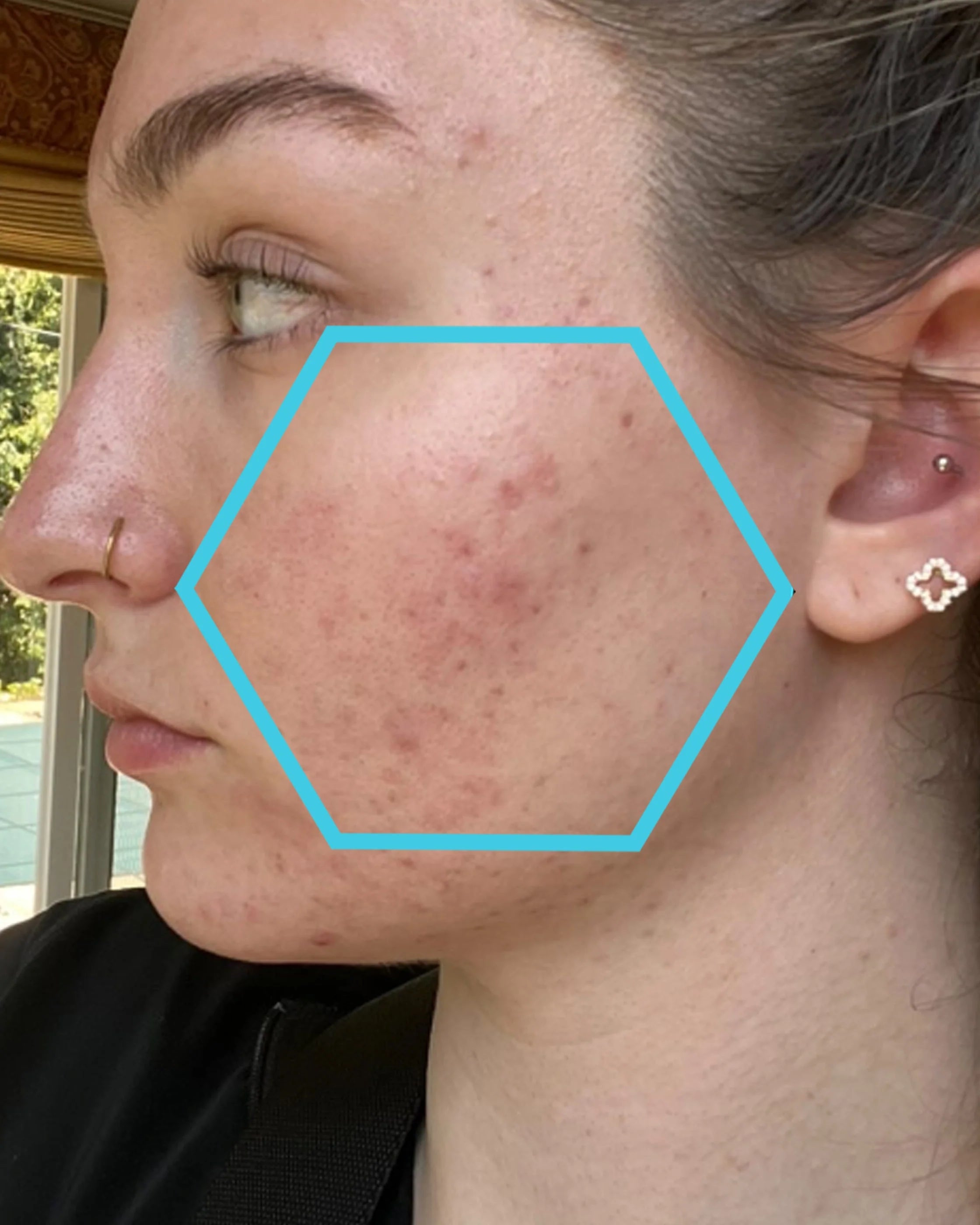 Close-up of a person's face with acne, wearing earrings and a nose ring.