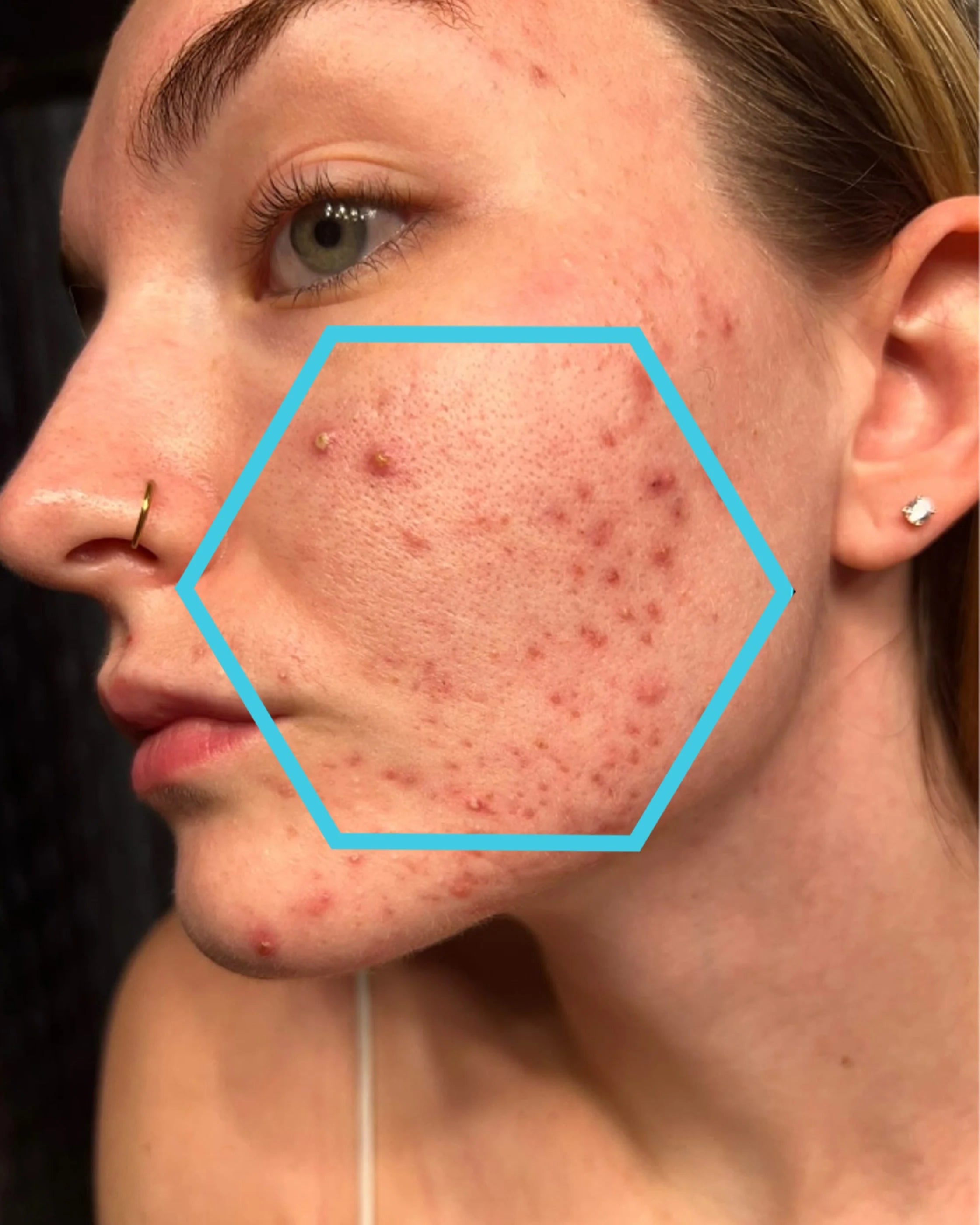Close-up of a person's face with acne on their cheek, highlighted by a blue hexagon.