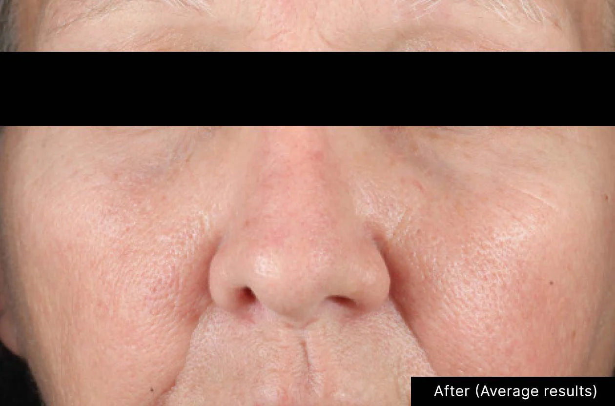 Close-up of a person's nose with a black bar over it, labeled 'After (Average results)'.