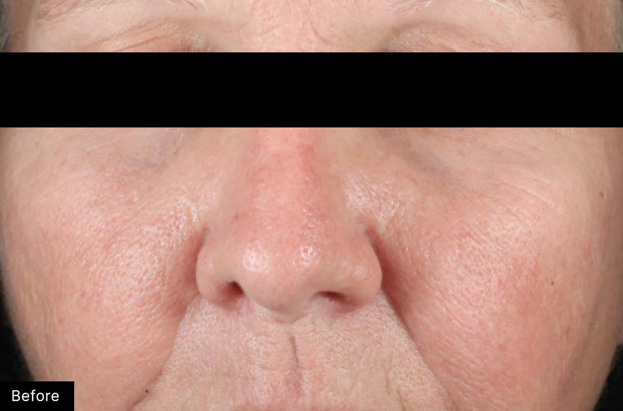 Close-up of a person's face with a black bar over the eyes, labeled 'Before'.