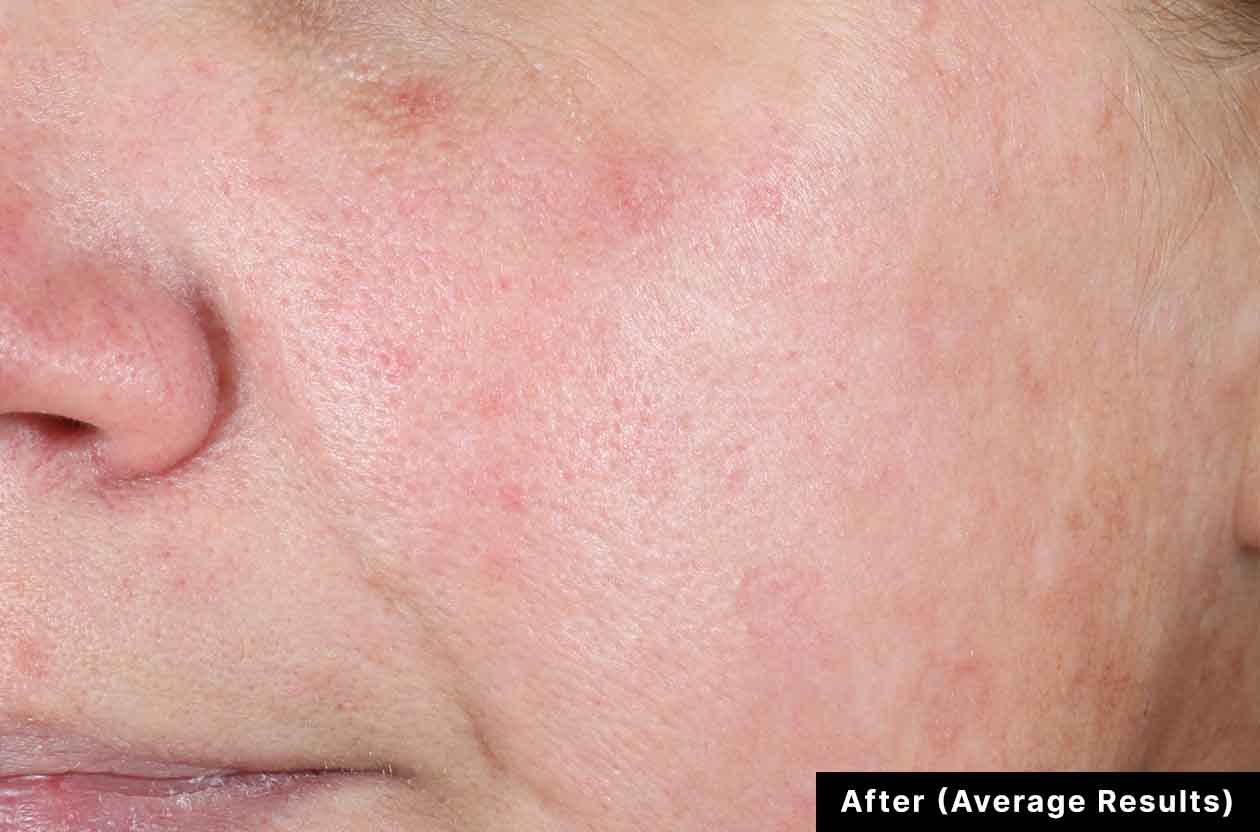 Close-up of a person's face with acne scars labeled 'After (Average Results)'.