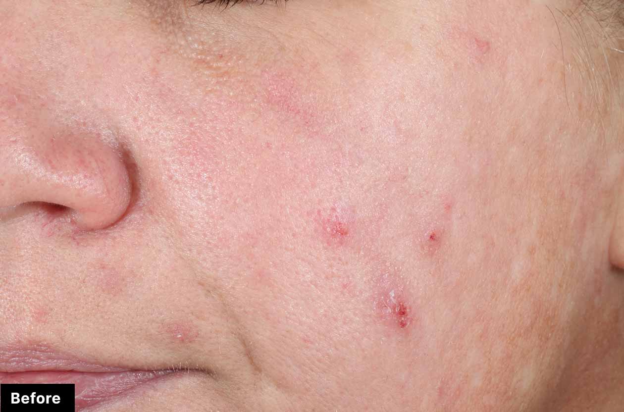 Close-up of a person's face with visible acne before treatment.