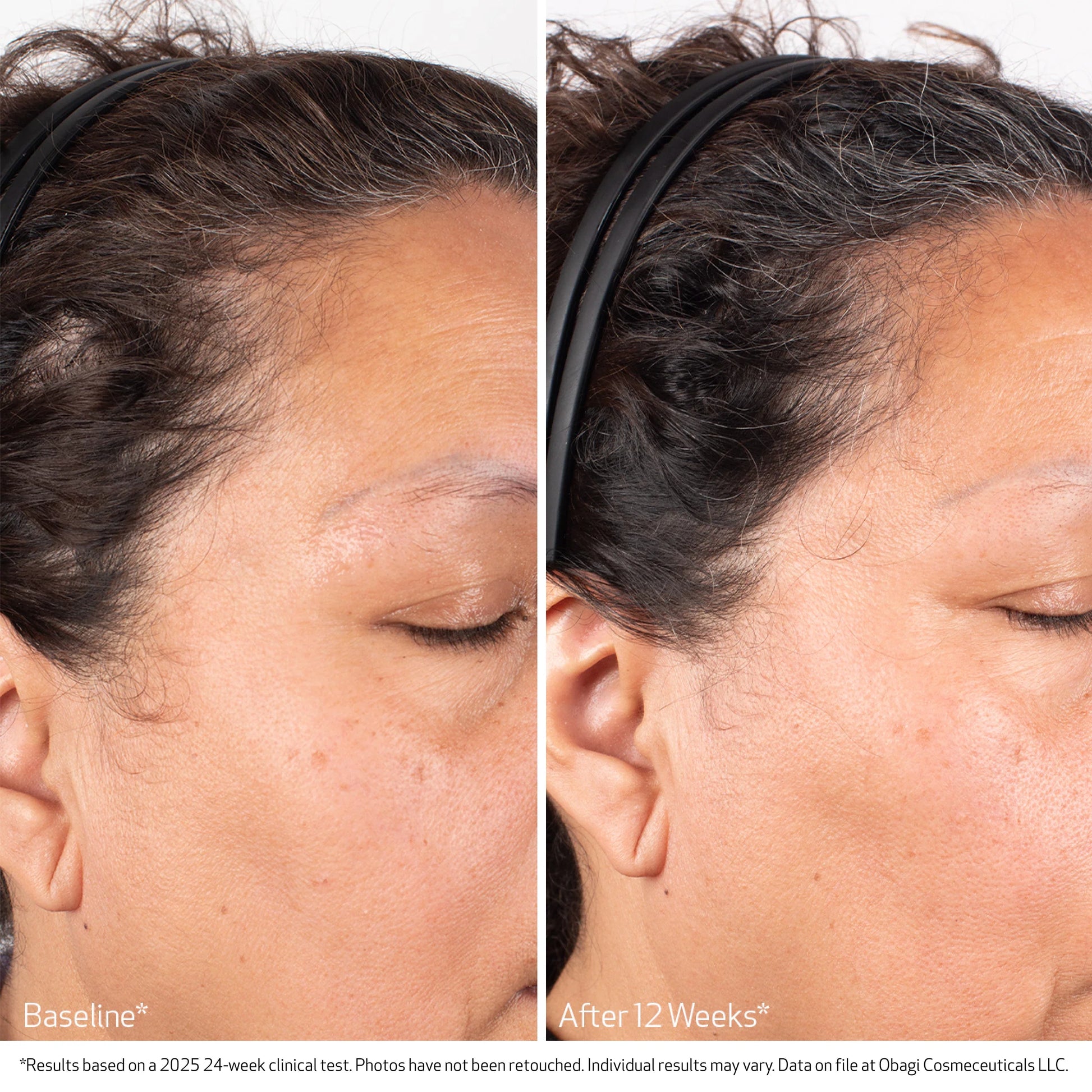 Before and after comparison of a woman's face with visible skin improvement over 12 weeks.