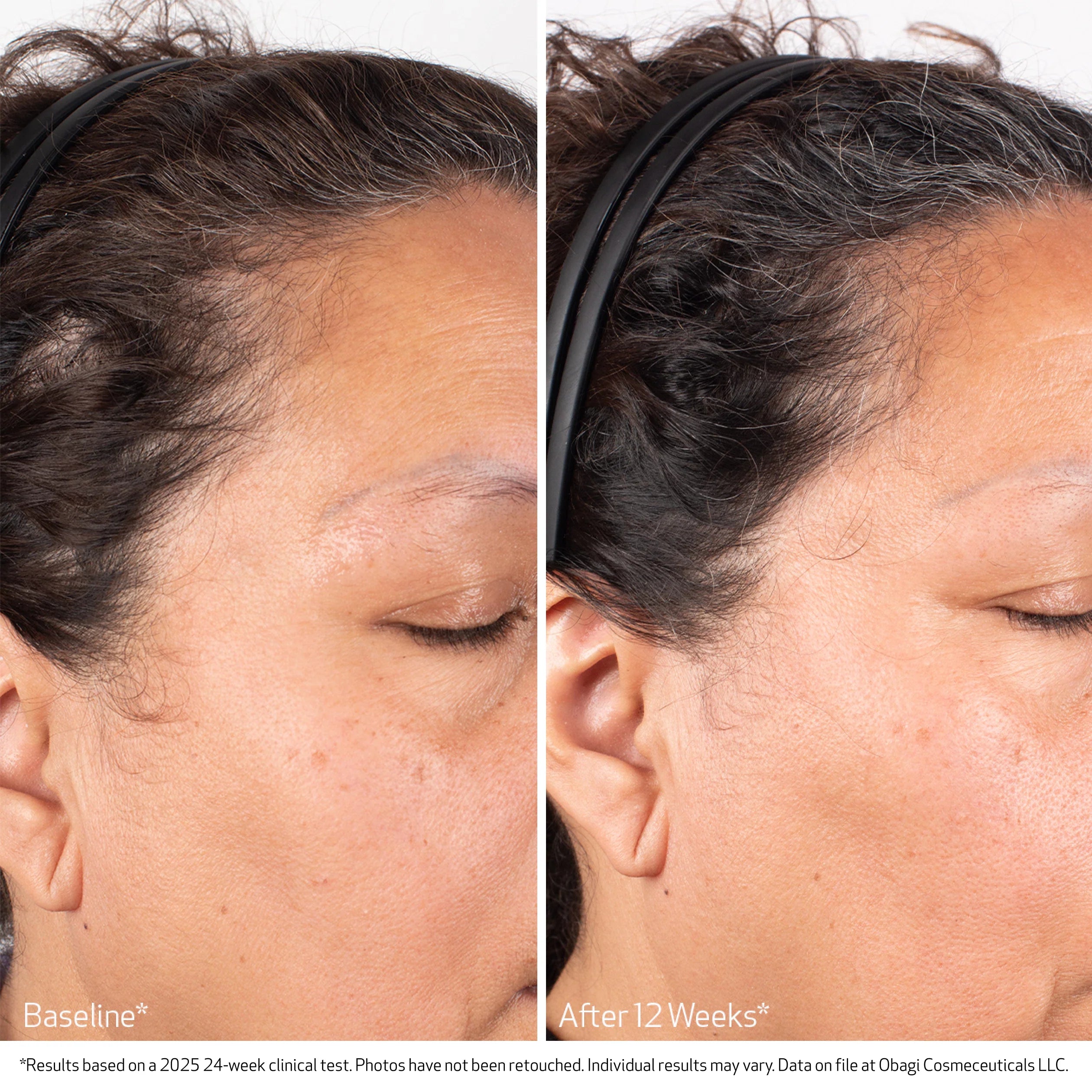 Before and after comparison of a woman's face with visible skin improvement over 12 weeks.