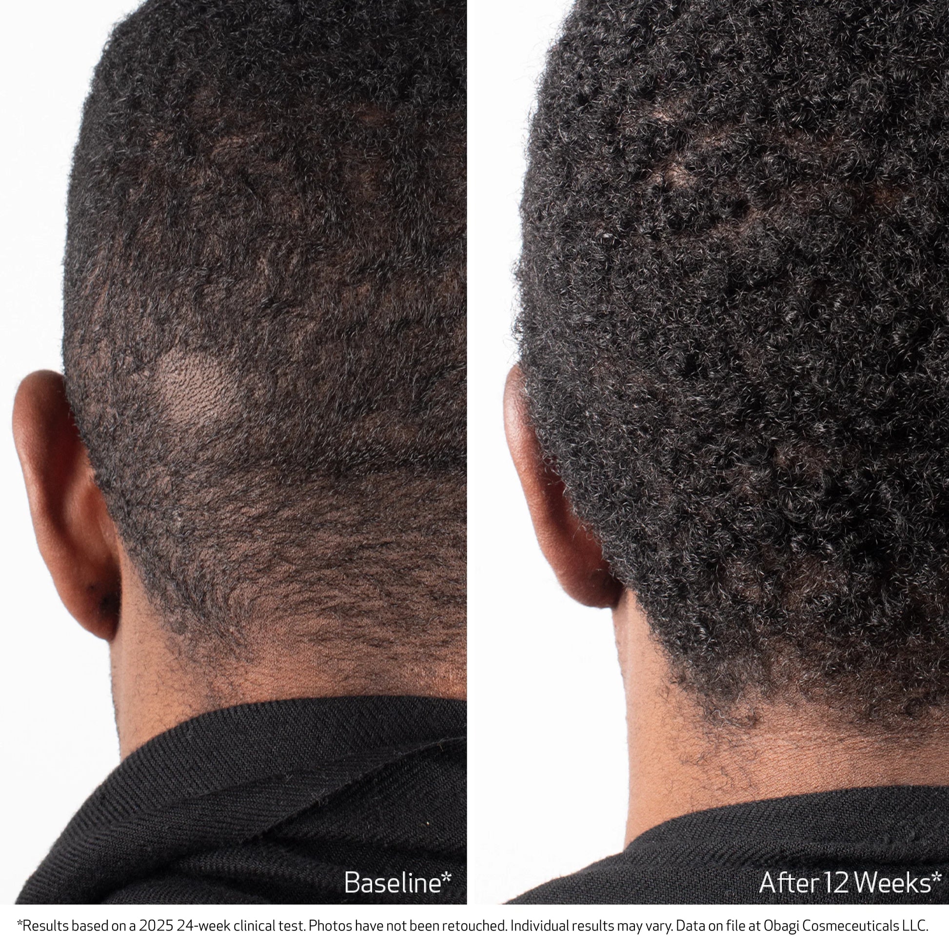 Before and after comparison of hair growth on a person's head.