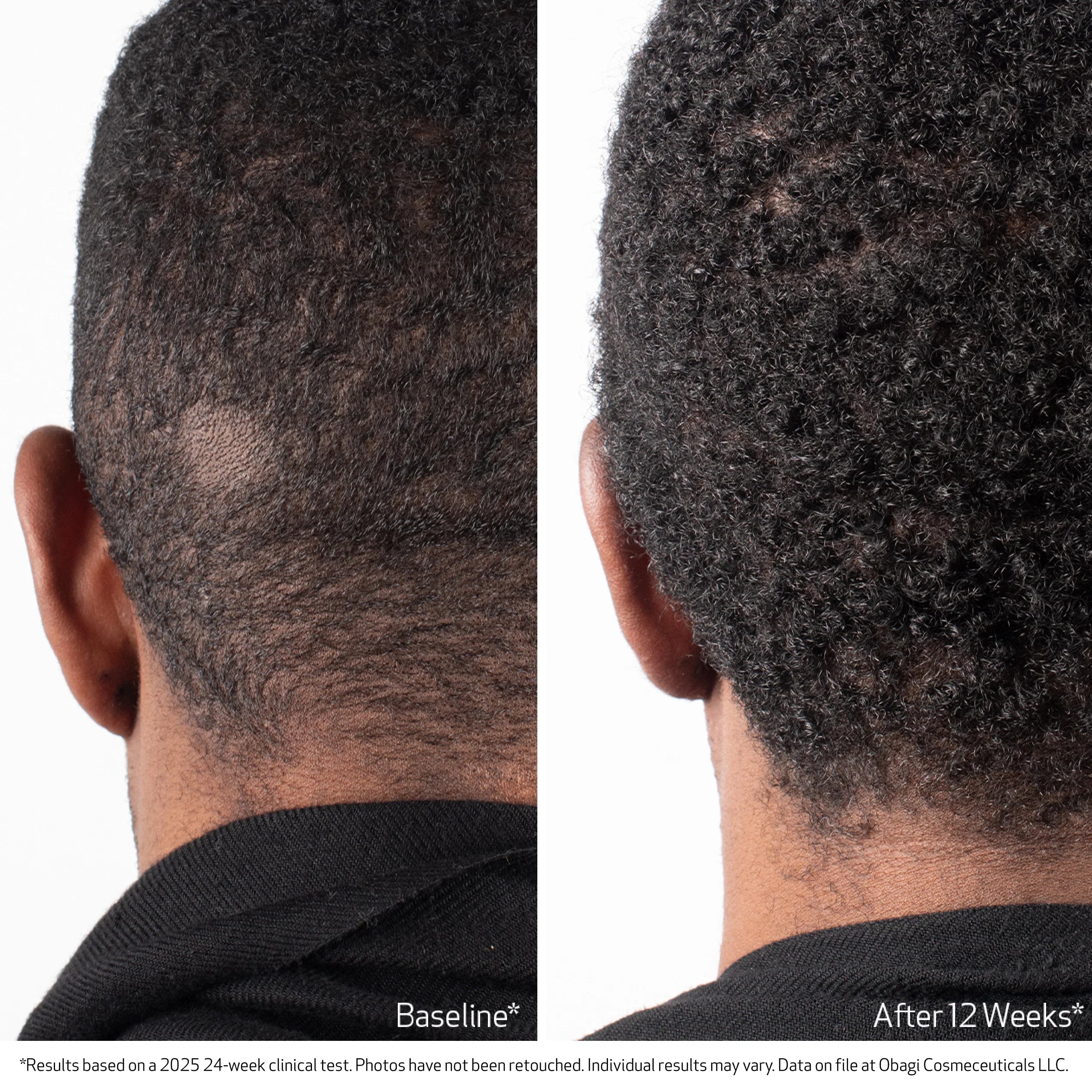 Before and after comparison of hair growth on a person's head.