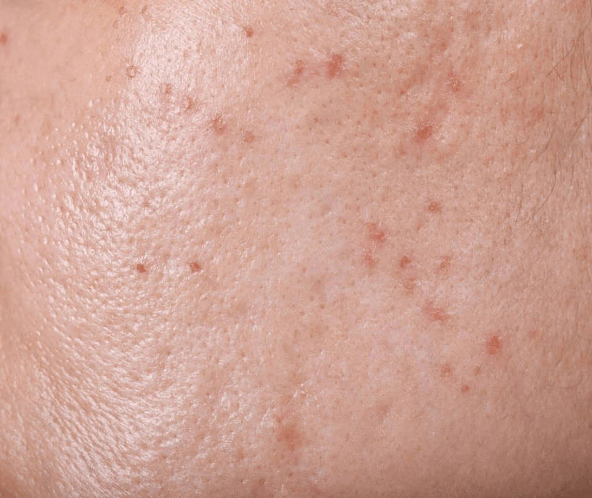 Close-up of skin with small red spots