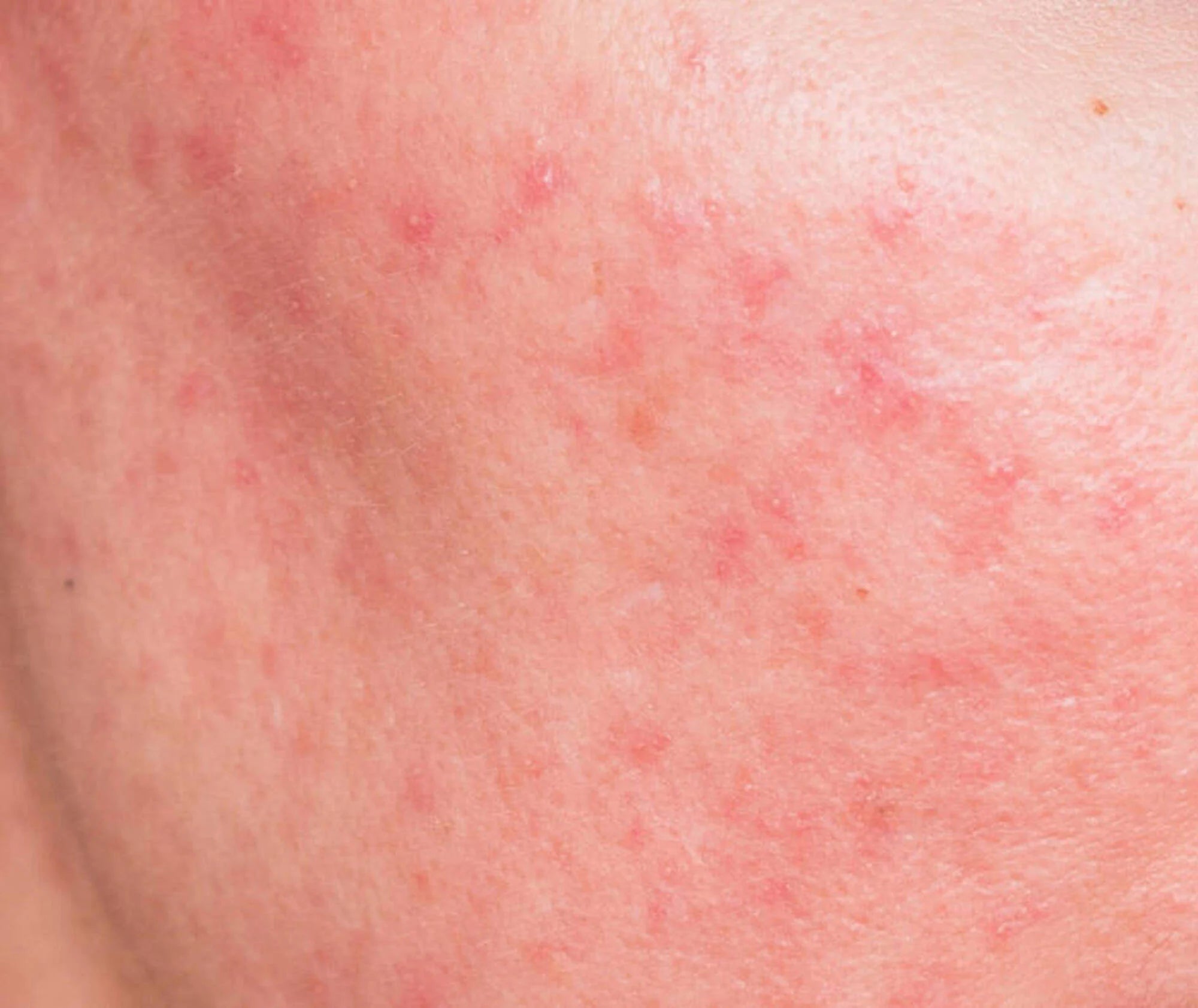 Close-up of skin with redness and small bumps