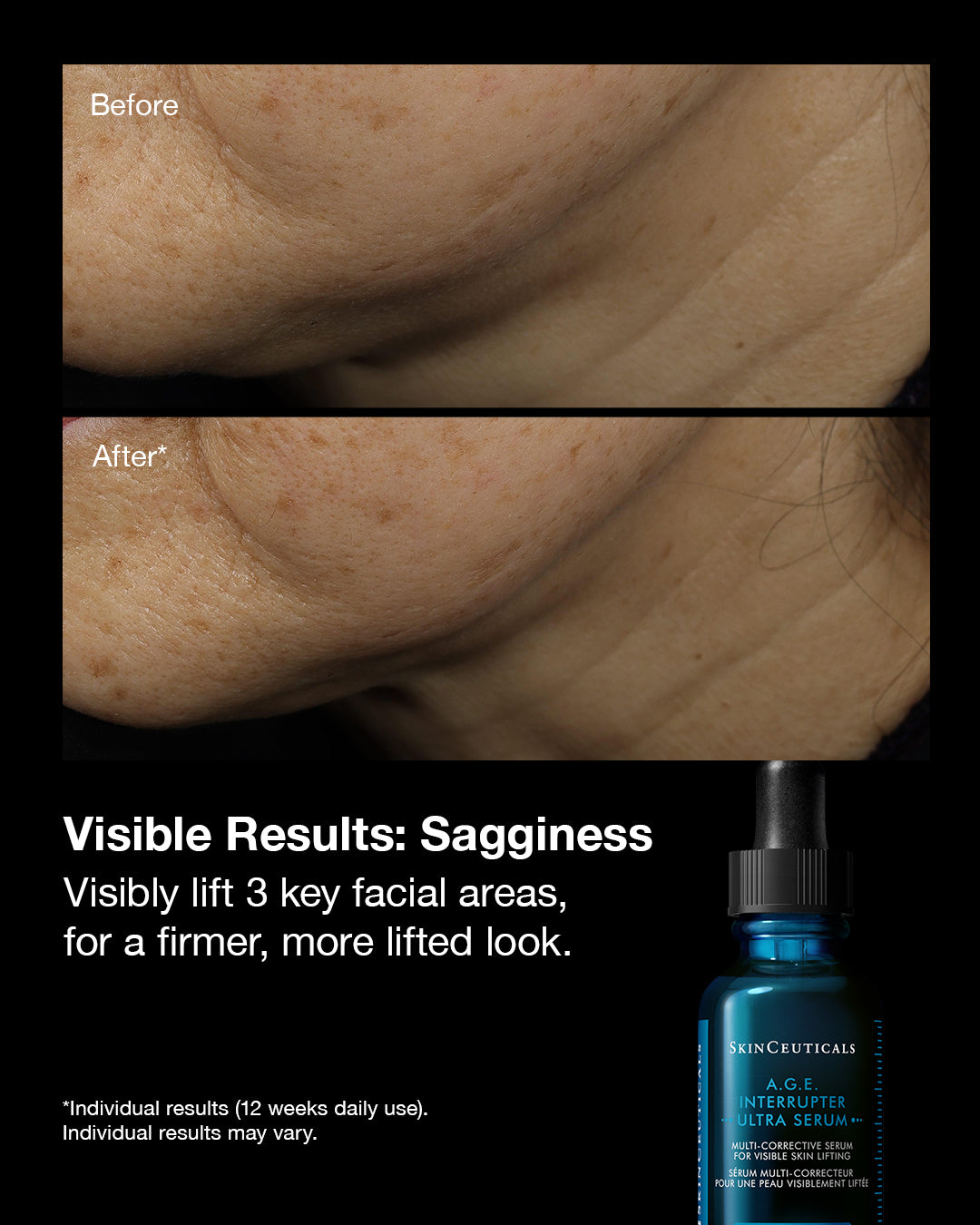 Before and after comparison of sagging skin with a bottle of SkinCeuticals AGE Interrupter Serum.
